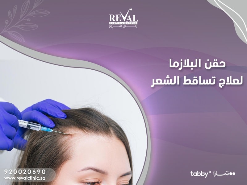 حقن البلازما لعلاج الصلع الوراثي وتساقط الشعر
