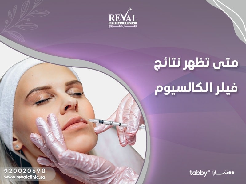 متى تظهر نتائج فيلر الكالسيوم