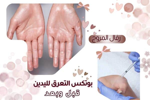 بوتوكس فرط التعرق لليدين قبل وبعد