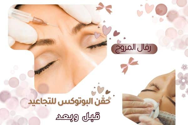 البوتوكس للتجاعيد: قبل وبعد