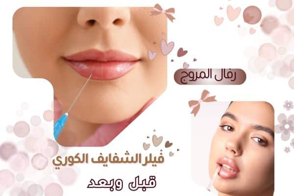 فيلر الشفايف الكوري قبل وبعد
