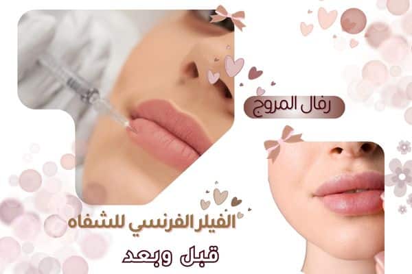 الفيلر الفرنسي للشفاه قبل وبعد