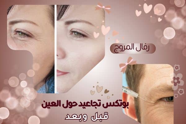 بوتكس تجاعيد العين قبل وبعد