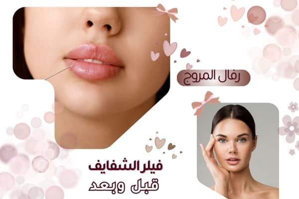 أنواع فيلر الشفايف