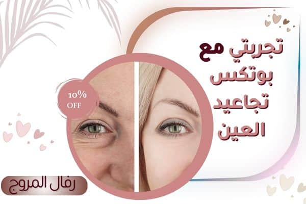تجربتي مع حقن بوتكس تجاعيد الوجه