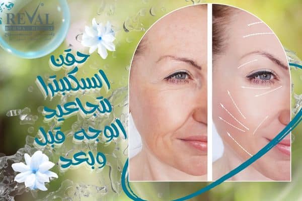 حقن السكلبترا لتجاعيد الوجه قبل وبعد