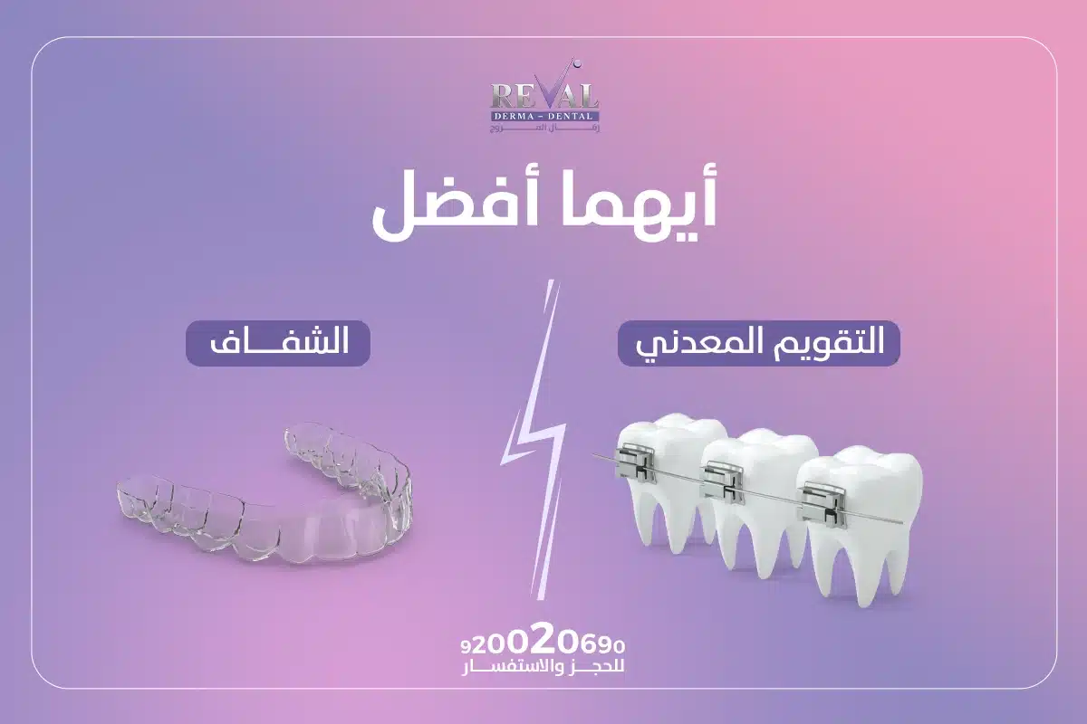 أيهما أفضل التقويم المعدني أم الشفاف؟ من أسرع التقويم الشفاف أم المعدني؟