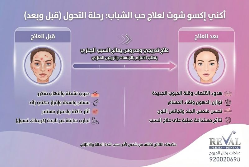 قبل وبعد اكني اكسو شوت لعلاج حب الشباب