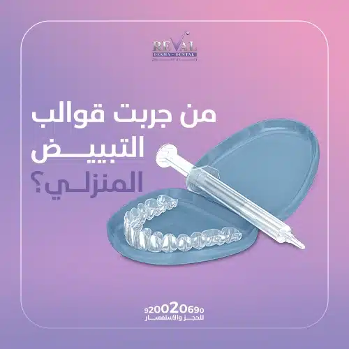 متى تظهر نتيجة تبييض الأسنان بالقوالب؟
