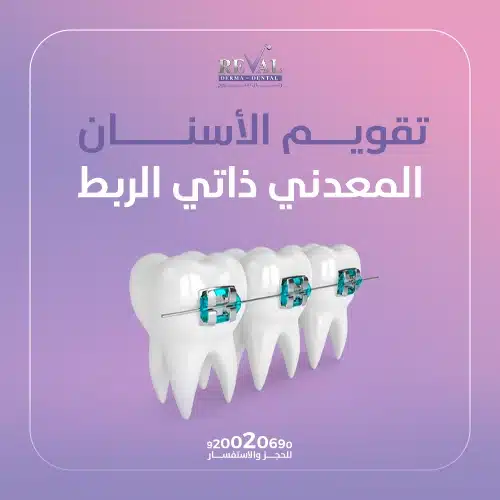 تجربتي مع تقويم الأسنان المعدني ذاتي الربط