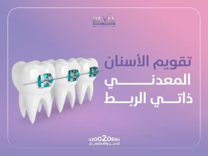 تقويم الأسنان المعدني ذاتي الربط: هل التقويم المعدني مؤلم؟