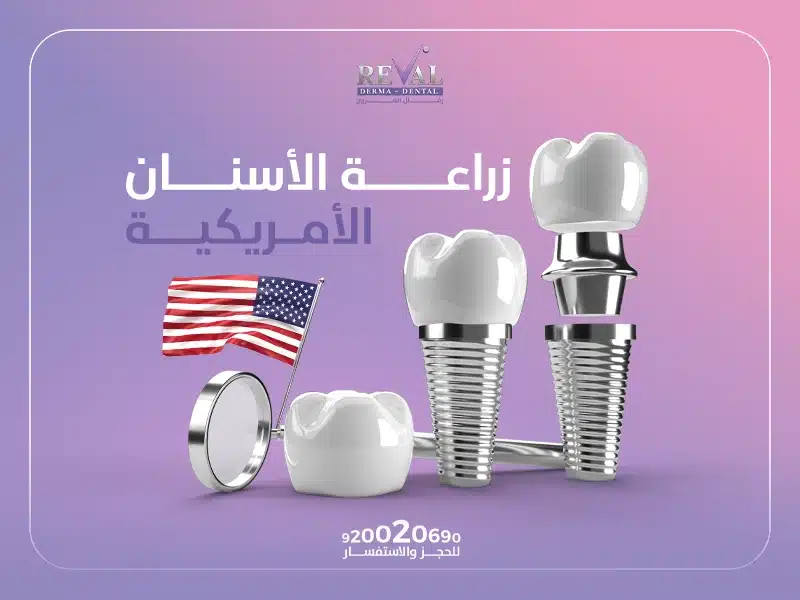 زراعة الأسنان الأمريكية: أي زراعة أسنان تدوم أطول فترة؟