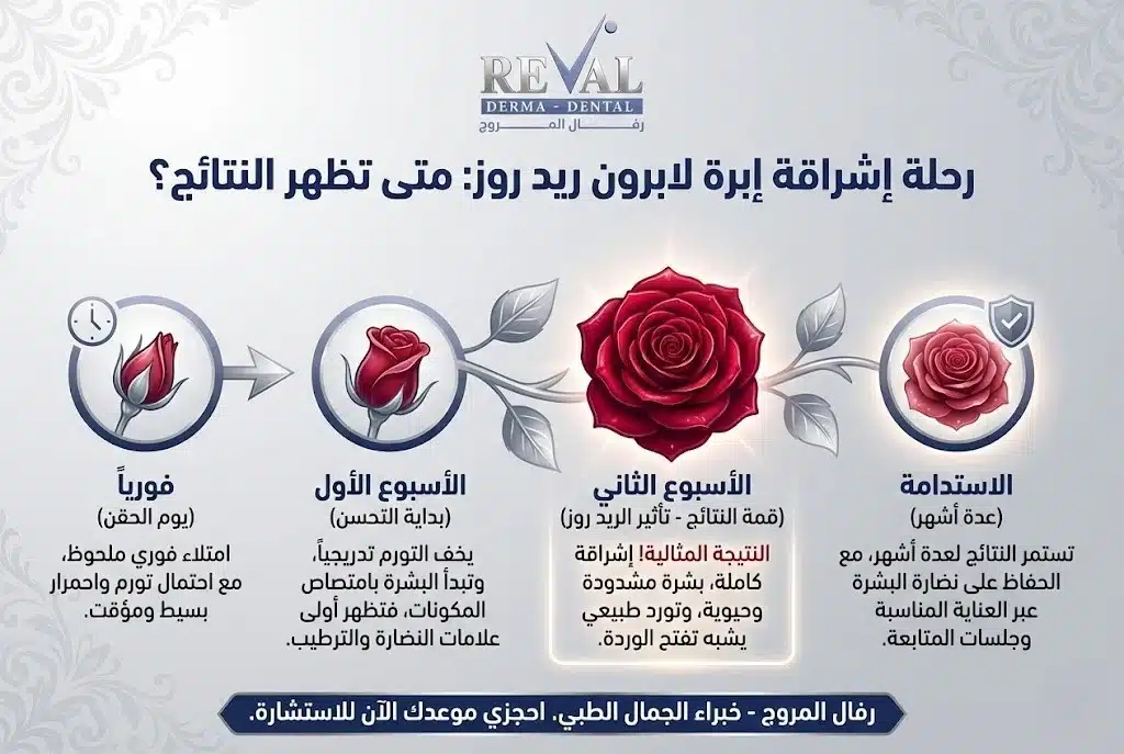 تجربتي مع إبرة لابرون ريد روز: ما هي حقن ريد روز؟