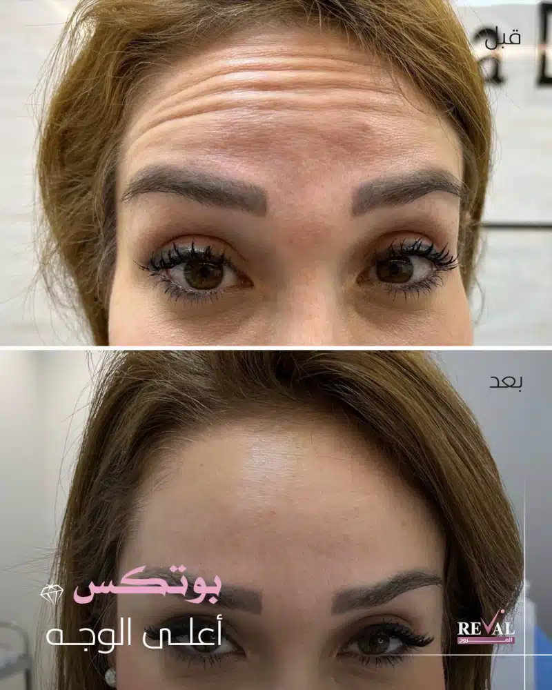 عروض بوتكس أعلى الوجه في العيد