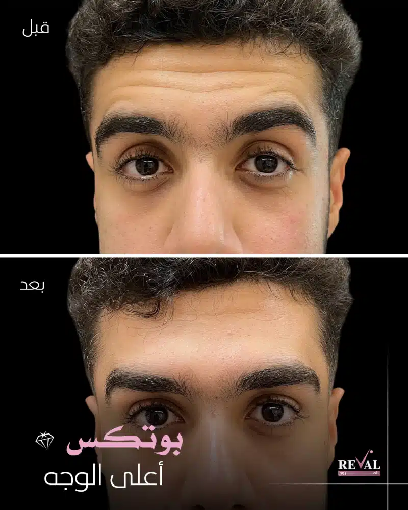 عروض العيد على جلسات بوتكس الجبهة