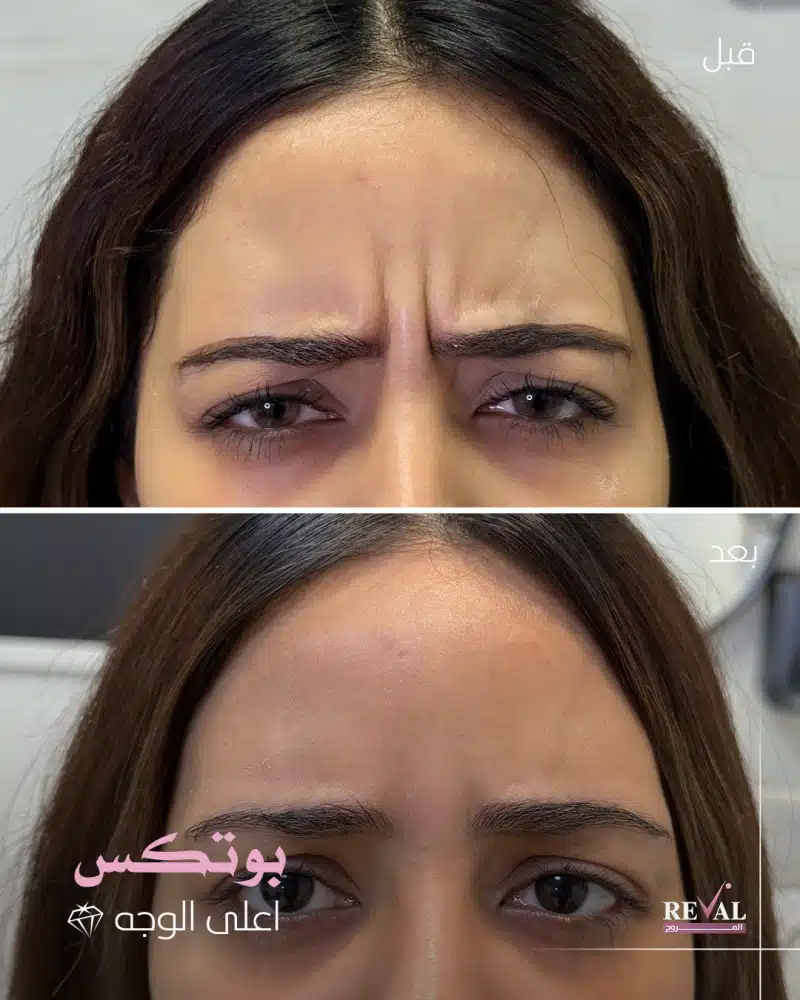 عروض بوتكس الجبهه في العيد