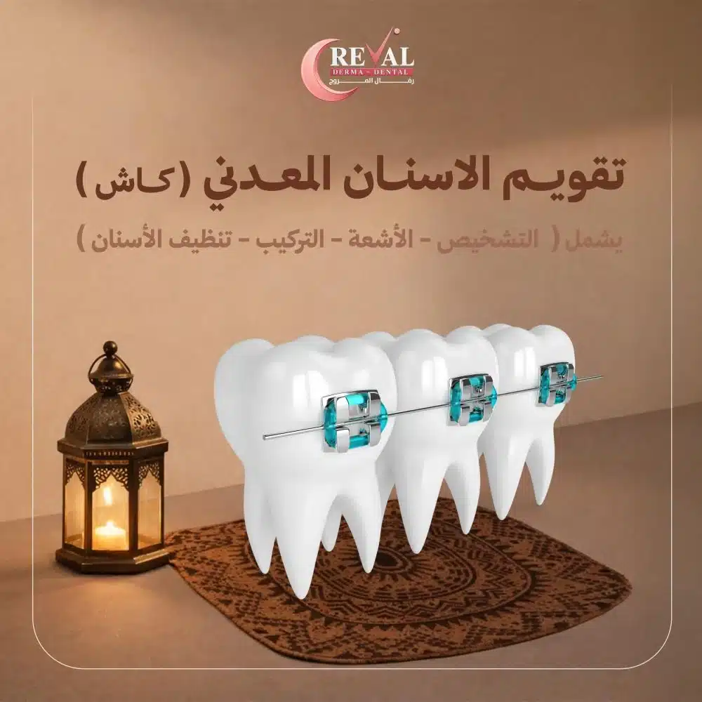باقة تقويم الأسنان المعدني (كاش)