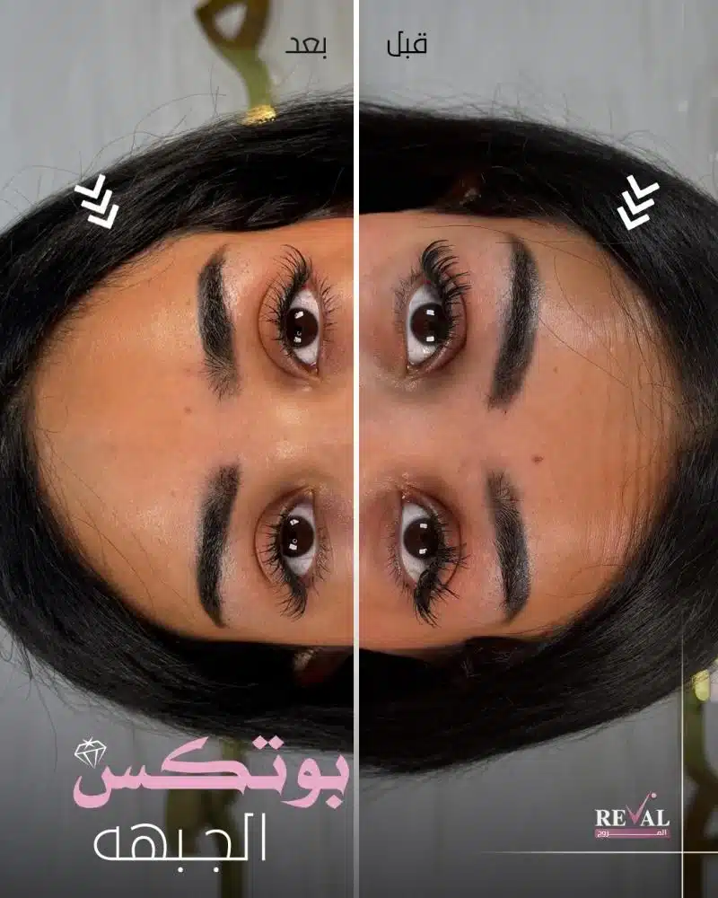 بوتكس الجبهة قبل وبعد