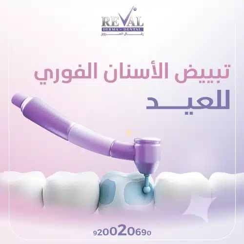 تجربتي مع تبييض الأسنان بالليزر
