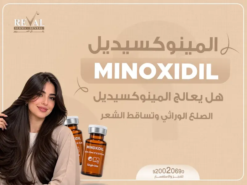 هل يعالج المينوكسيديل الصلع الوراثي وتساقط الشعر؟ دليل شامل 2027/2028