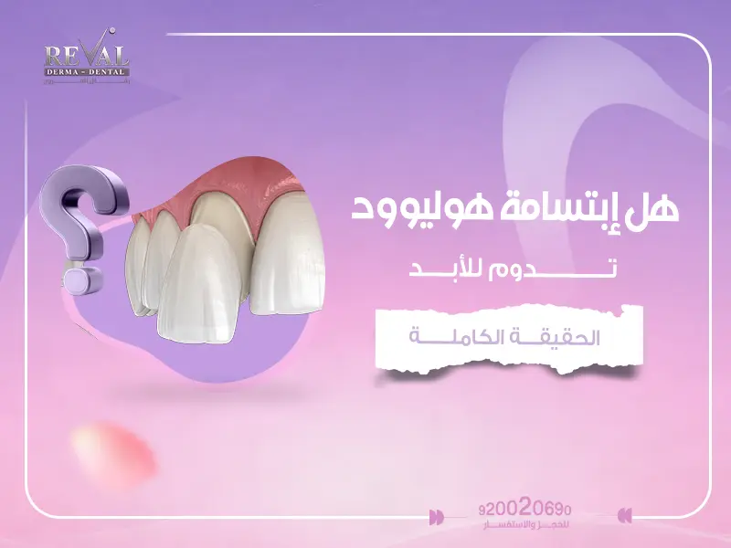 هل ابتسامة هوليود تدوم للأبد؟ أسرار تعرف عليها اولاً قبل اتخاذ قرارك👌