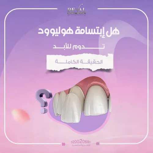 كم تدوم ابتسامة هولييود