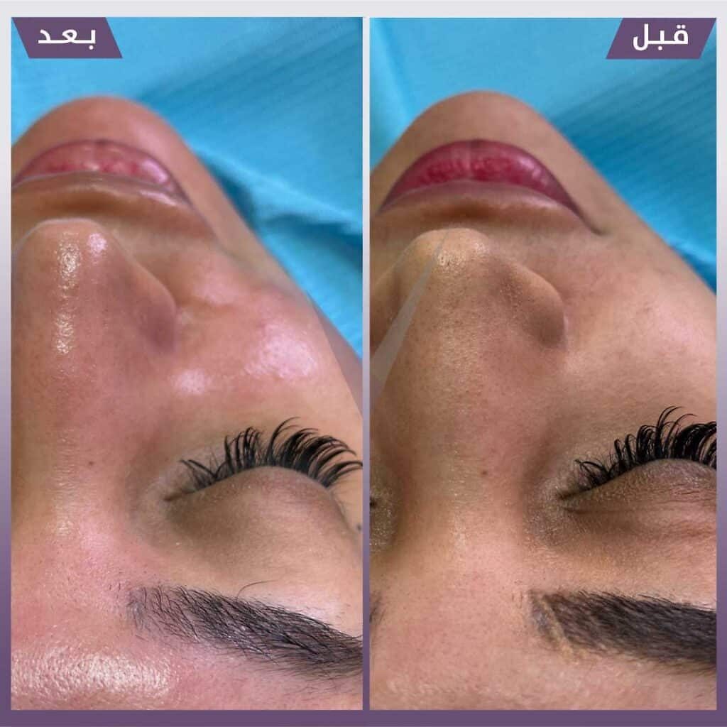 تنظيف بشرة هايدرافيشال