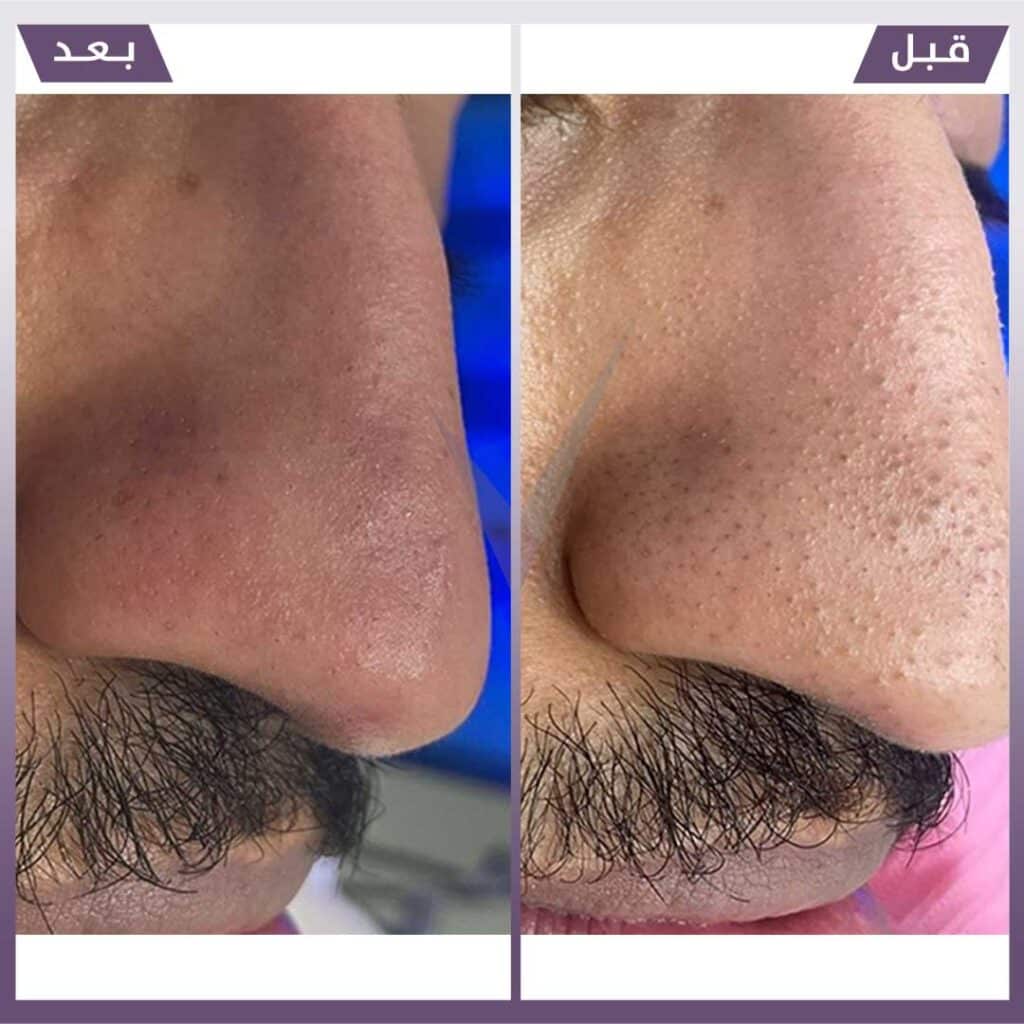 تنظيف بشرة هايدرافيشال