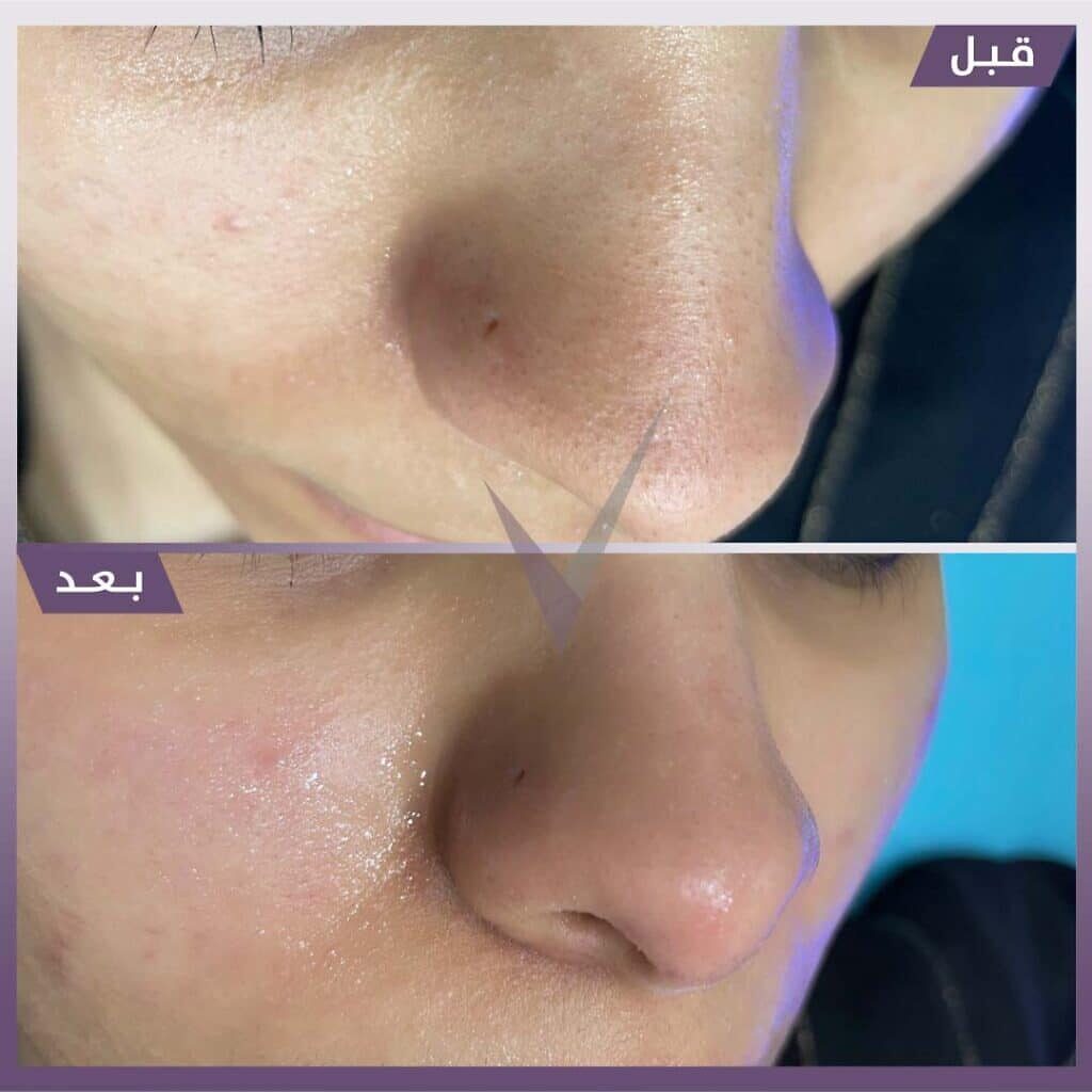 تنظيف بشرة هايدرافيشال