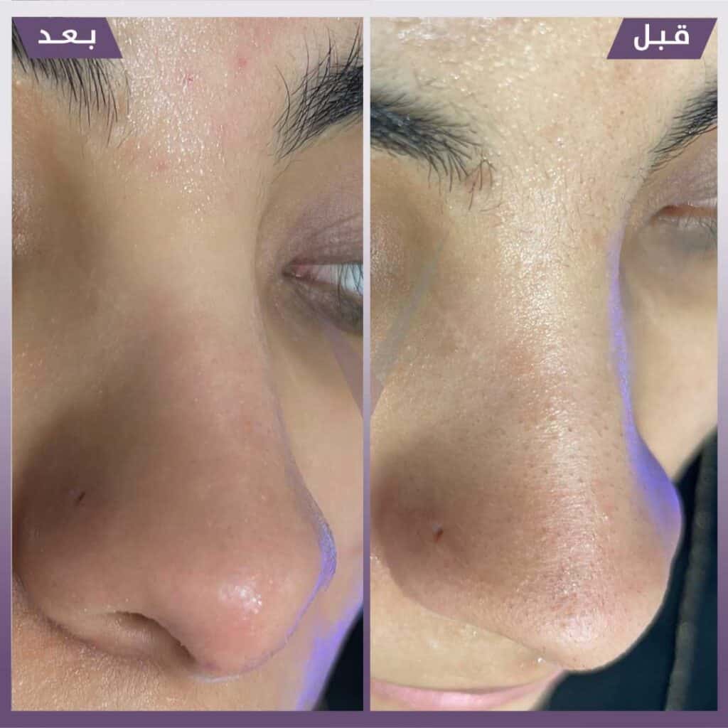تنظيف بشرة هايدرافيشال