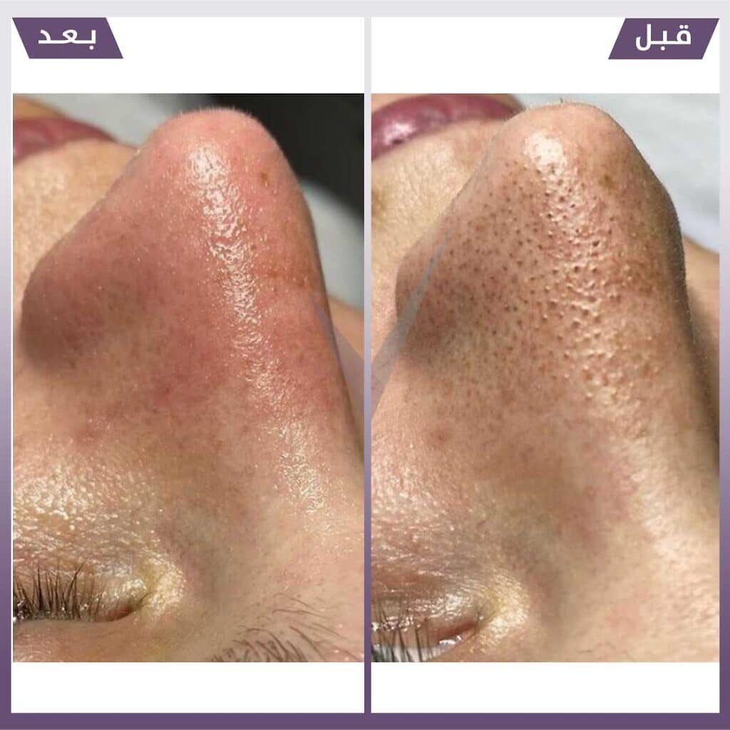 تنظيف بشرة هايدرافيشال