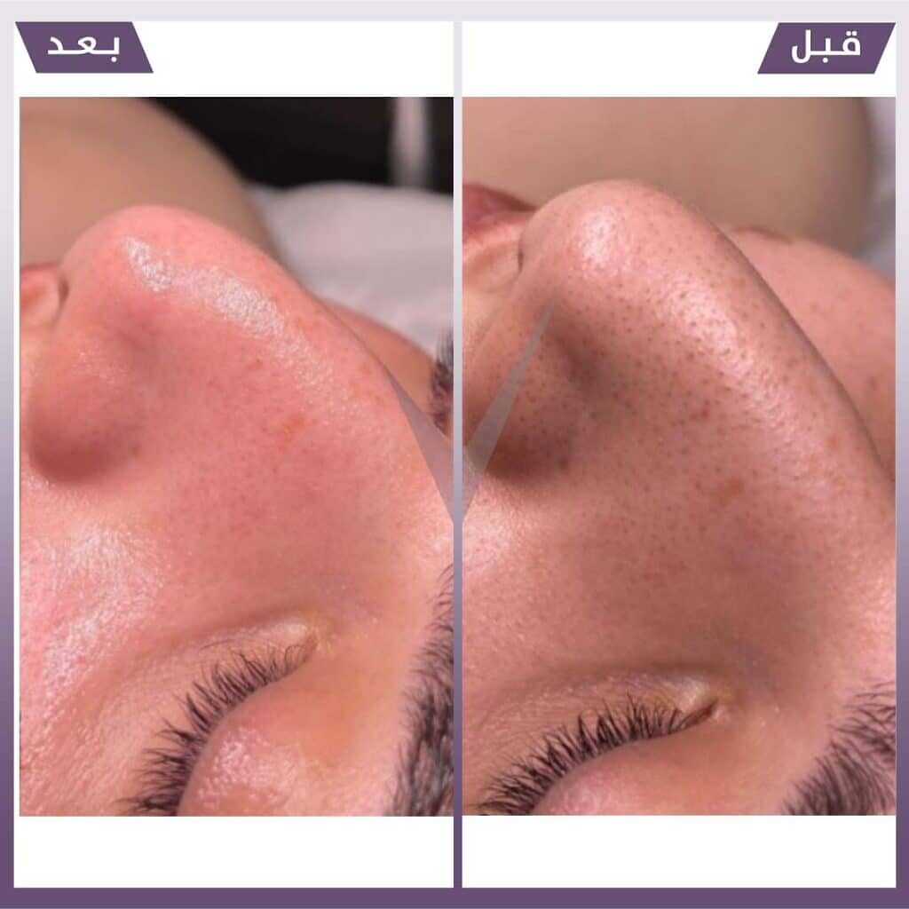 تنظيف بشرة هايدرافيشال