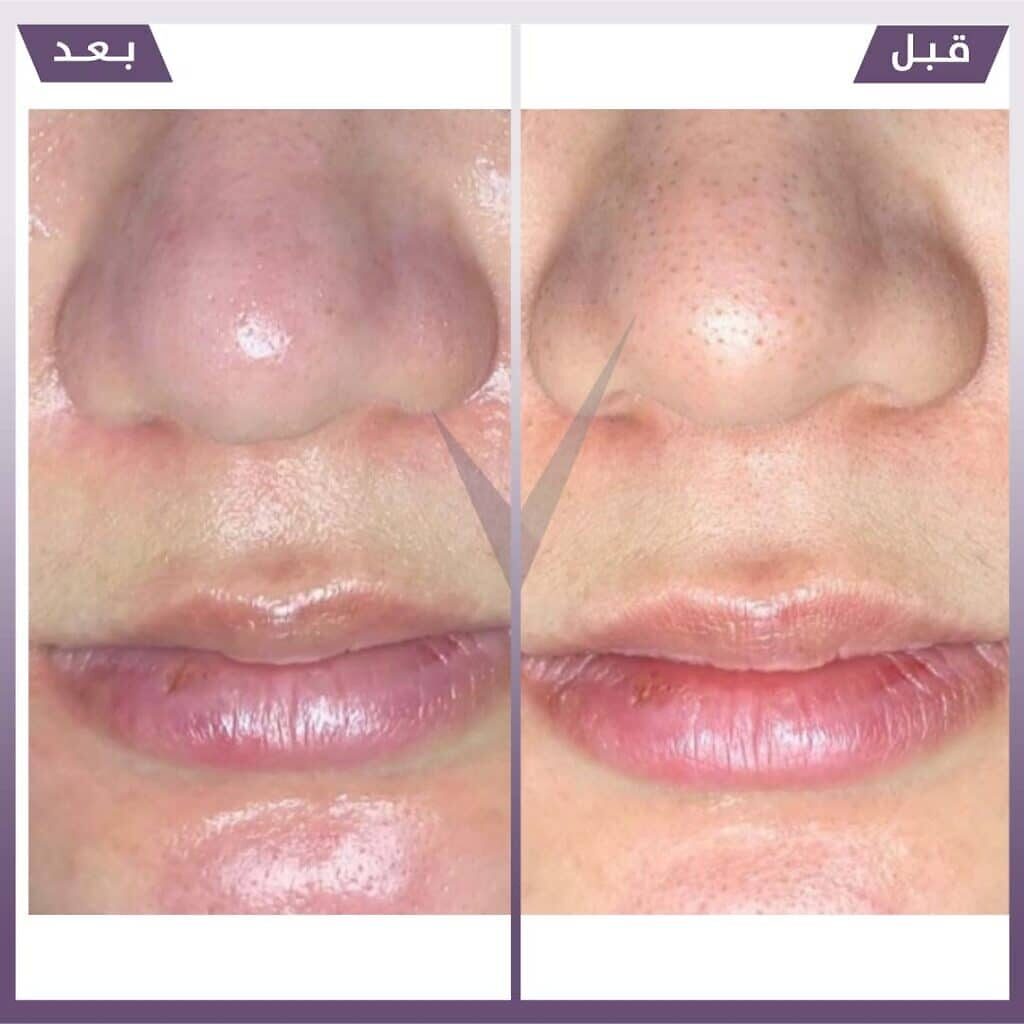 تنظيف بشرة هايدرافيشال