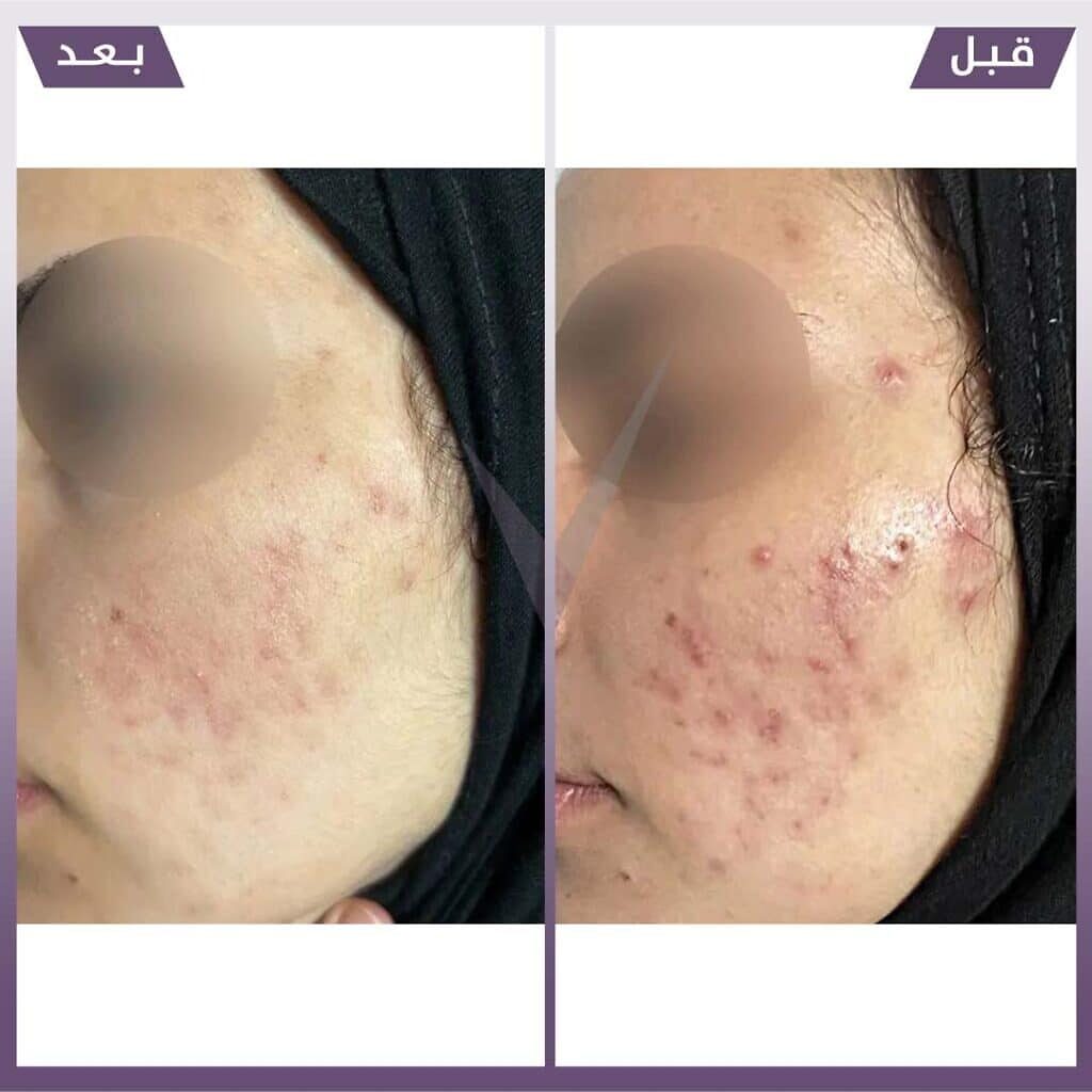 فراكشنال ليزر