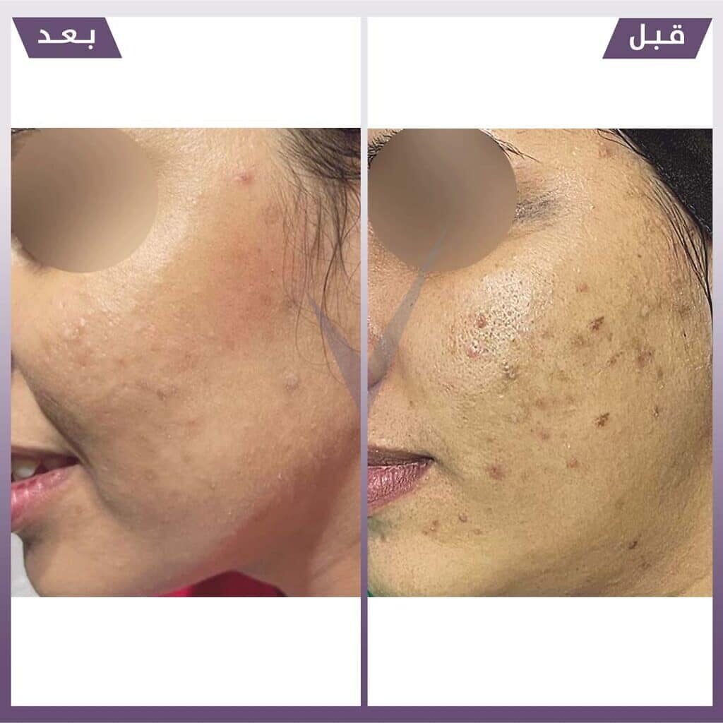 فراكشنال ليزر