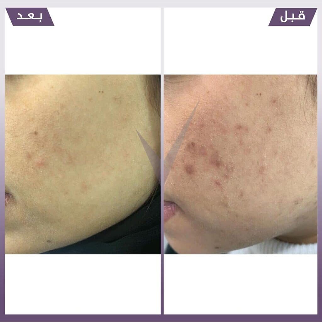 فراكشنال ليزر