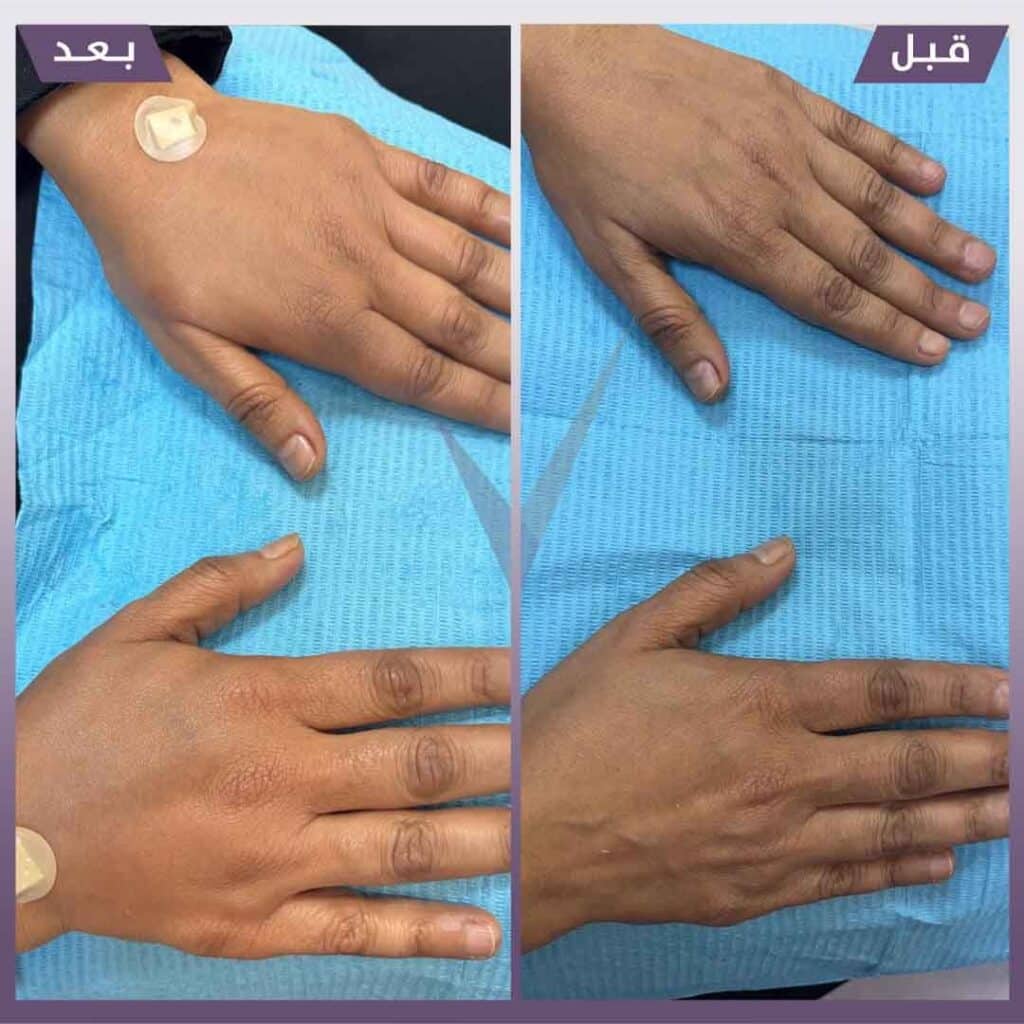 فيلر الكالسيوم للايدى