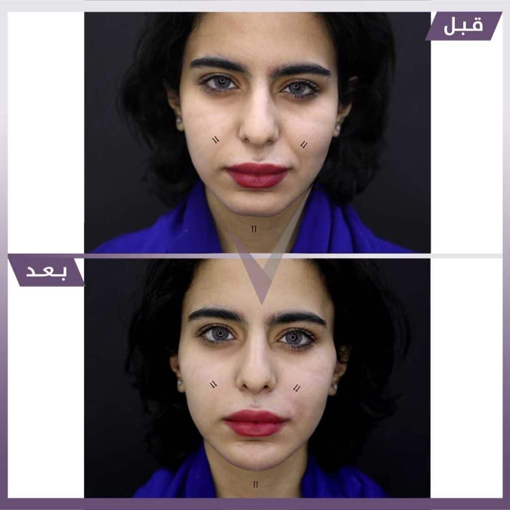 فيلر ذقن وخطوط الابتسامة