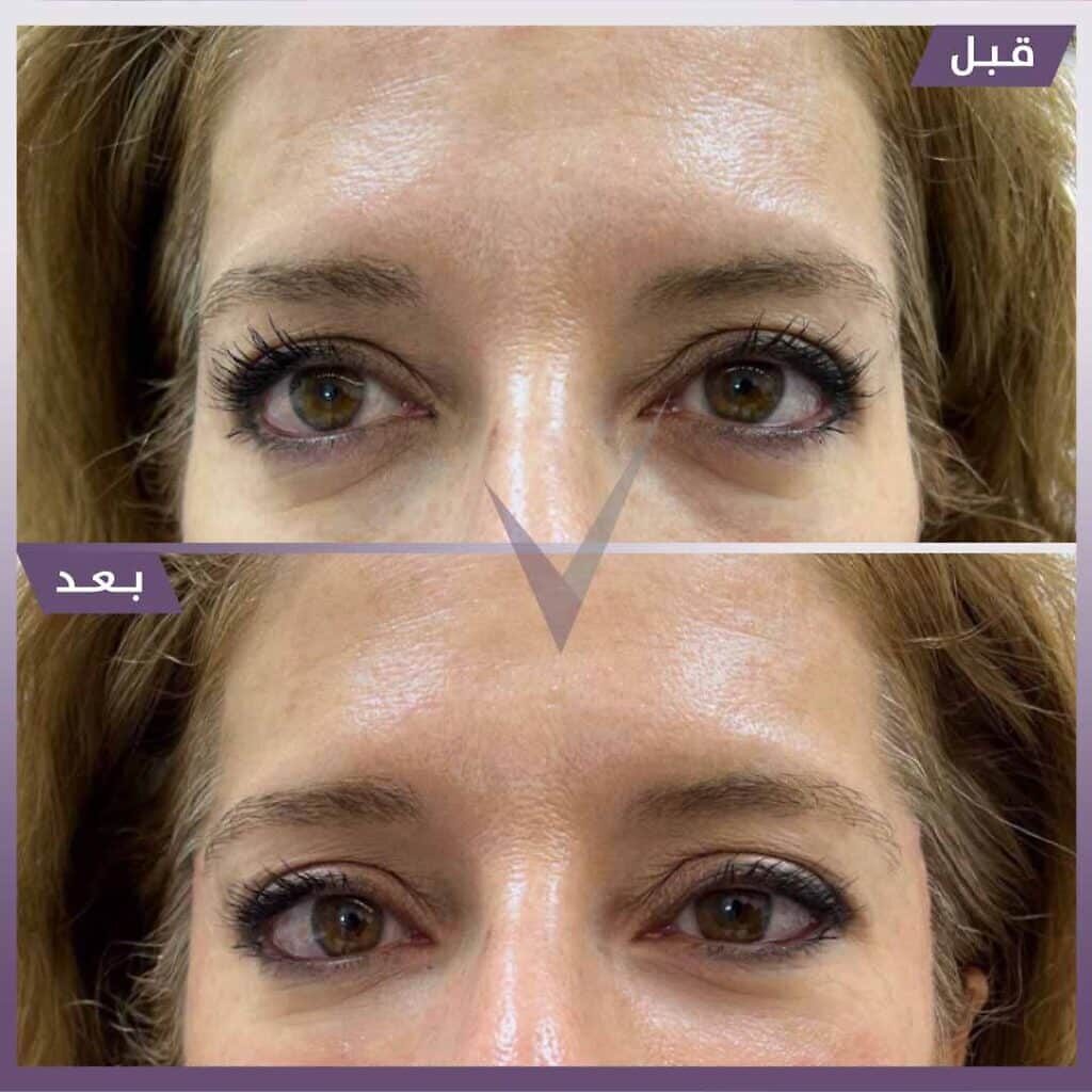 فيلر لعلاج التجويف والهالات