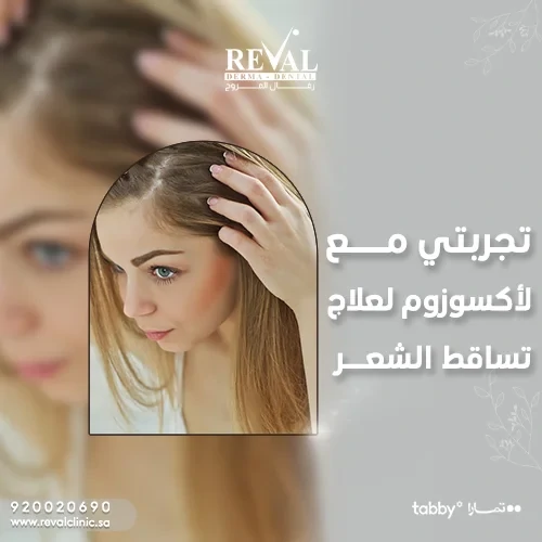 تجربتي مع الأكسوزوم لعلاج تساقط الشعر