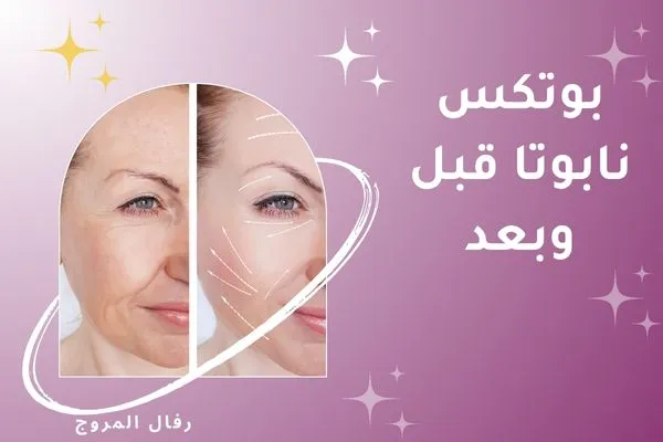 بوتكس نابوتا قبل وبعد
