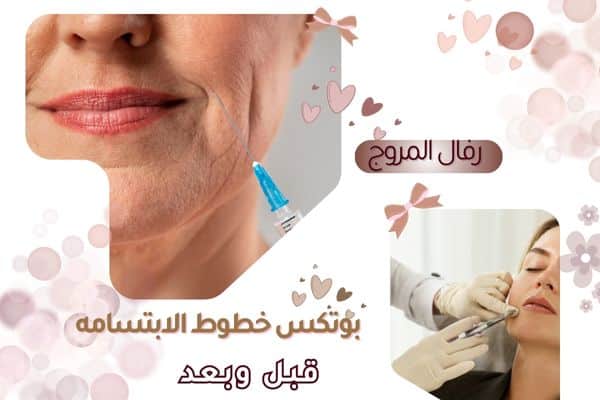بوتكس خطوط الابتسامة قبل ويعد