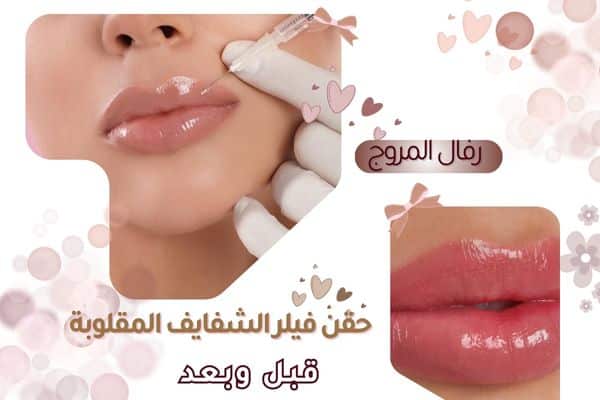 حقن فيلر الشفايف المقلوبة قبل وبعد