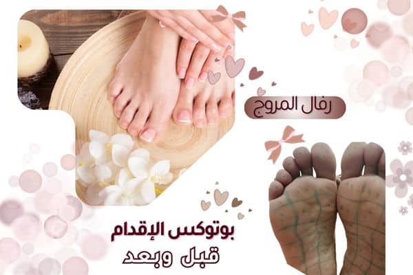  بوتكس التعرق للأقدام قبل وبعد