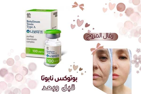 بوتكس نابوتا قبل وبعد