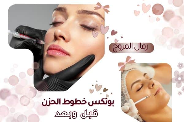 بوتكس خطوط الحزن قبل وبعد