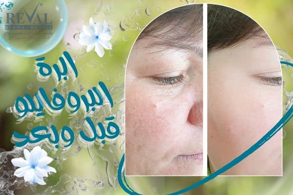اضرار ابرة البروفايلو_ابرة البروفايلو قبل وبعد