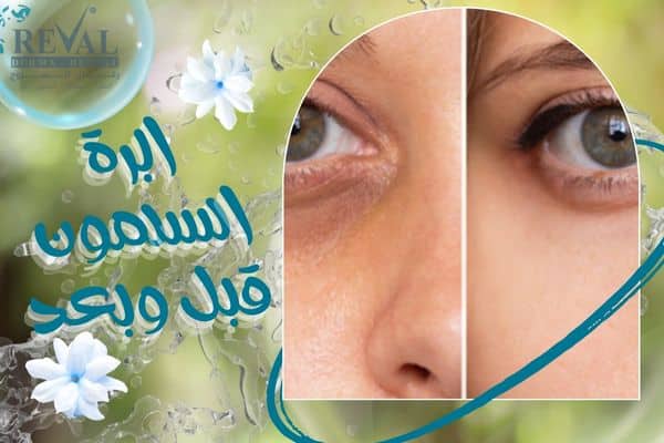 ابرة السلمون قبل وبعد