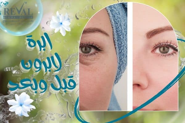 ابرة لابرون قبل وبعد