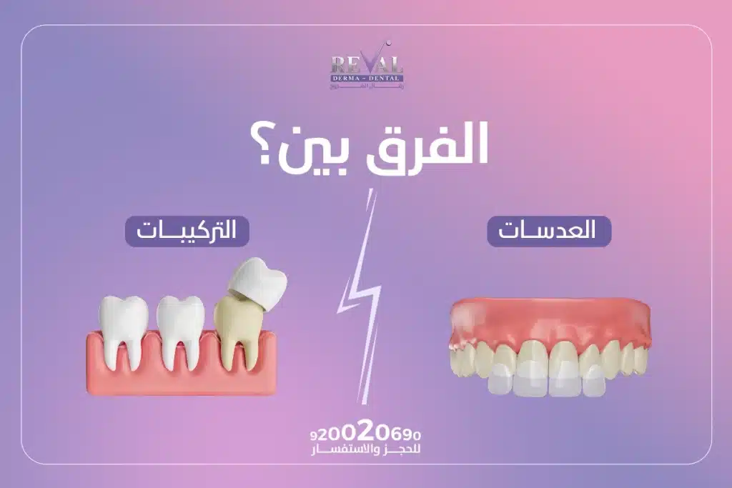 الفرق بين العدسات والتركيبات الأسنان: كيف تختار الابتسامة الأنسب لك👌
